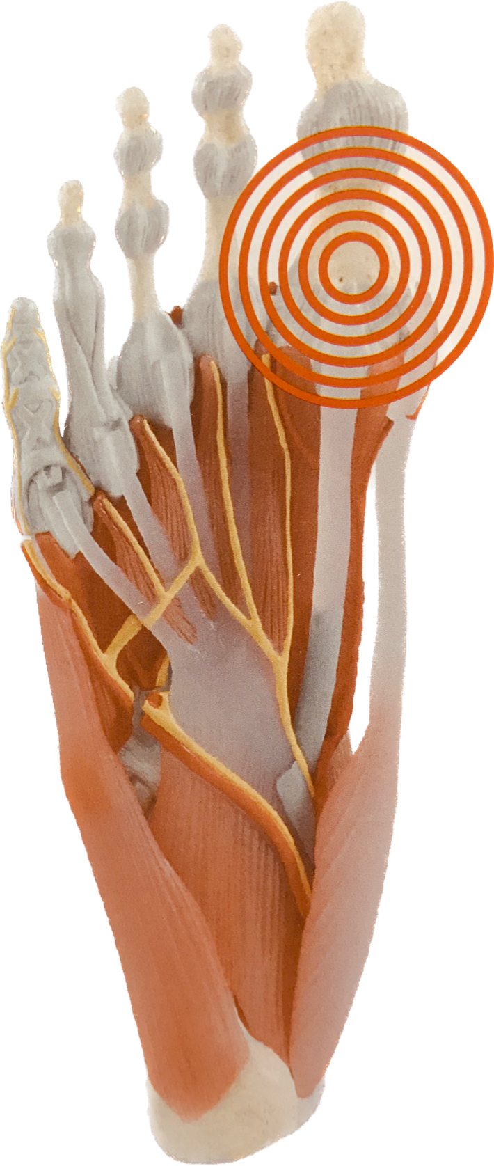 Novaped Hallux Rigidus Breed