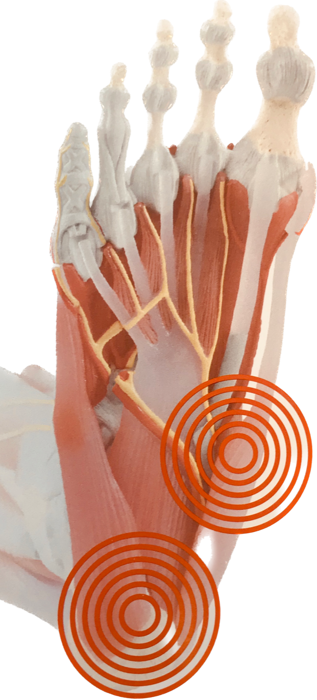 Producten Novaped Sport Zolen Running Fasciitis Plantarus Schulte